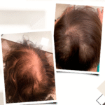 Alopecia Fibrosante Frontal: como a combinação certa de tratamentos pode preservar e transformar sua autoestima 1 140825 alexandre blog 1