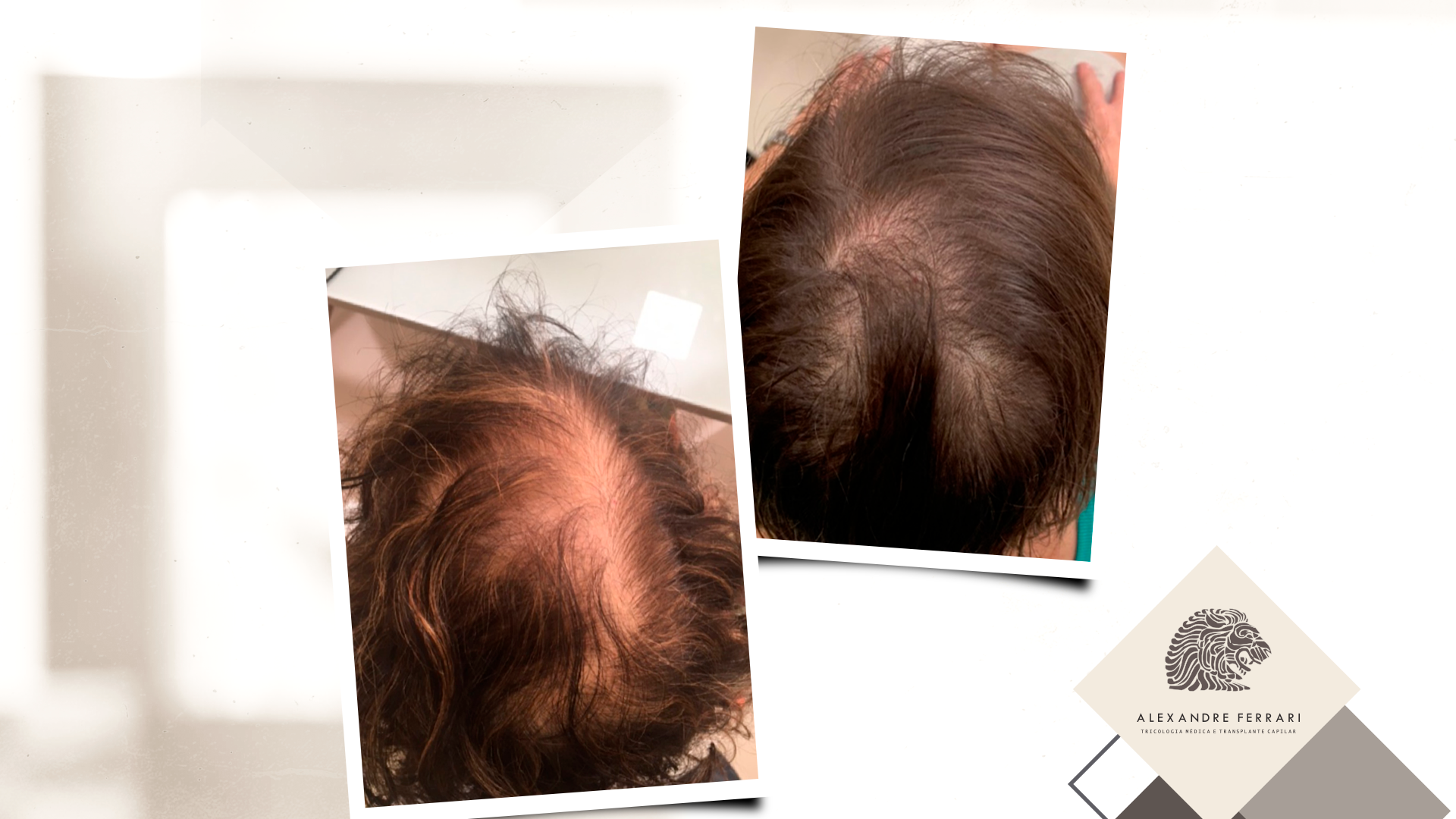 Alopecia Fibrosante Frontal: como a combinação certa de tratamentos pode preservar e transformar sua autoestima