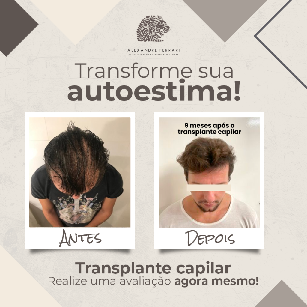 Transplante Capilar: Antes e Depois 2 1