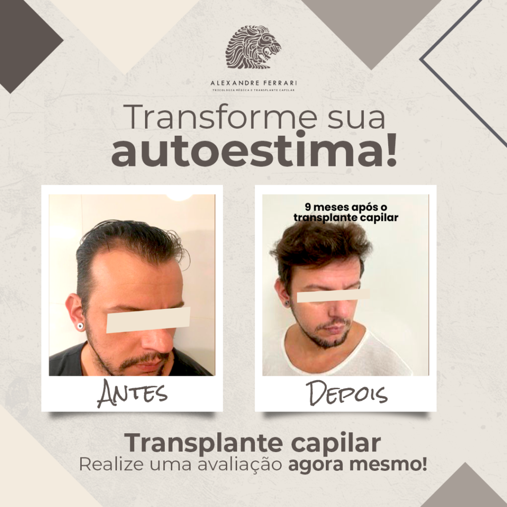 Transplante Capilar: Antes e Depois 3 2 1