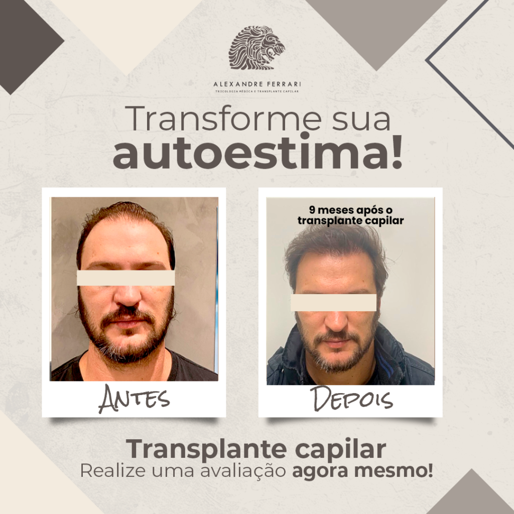 Transplante Capilar: Antes e Depois 4 3