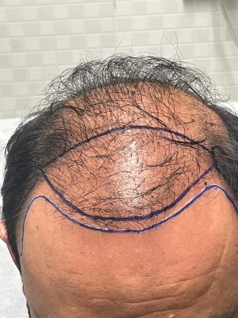 Transplante capilar: da raiz ao resultado – Por que escolher um especialista faz toda a diferença 5 WhatsApp Image 2025 06 23 at 09.08.58