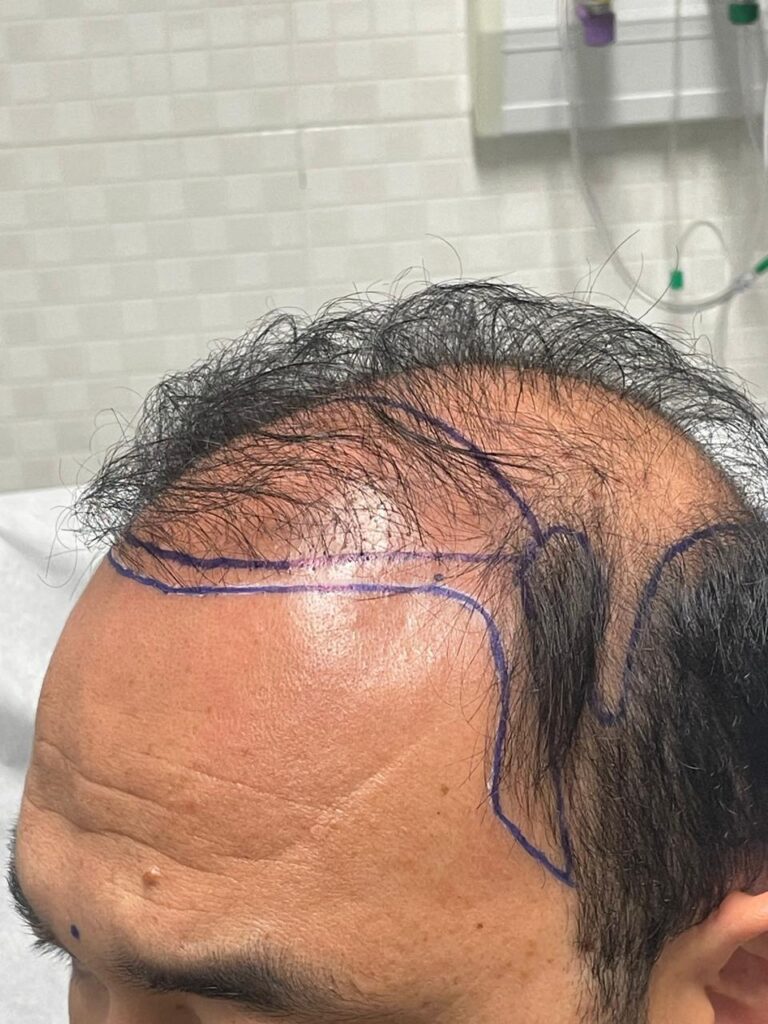 Transplante capilar: da raiz ao resultado – Por que escolher um especialista faz toda a diferença 3 WhatsApp Image 2025 06 23 at 09.08.59 1