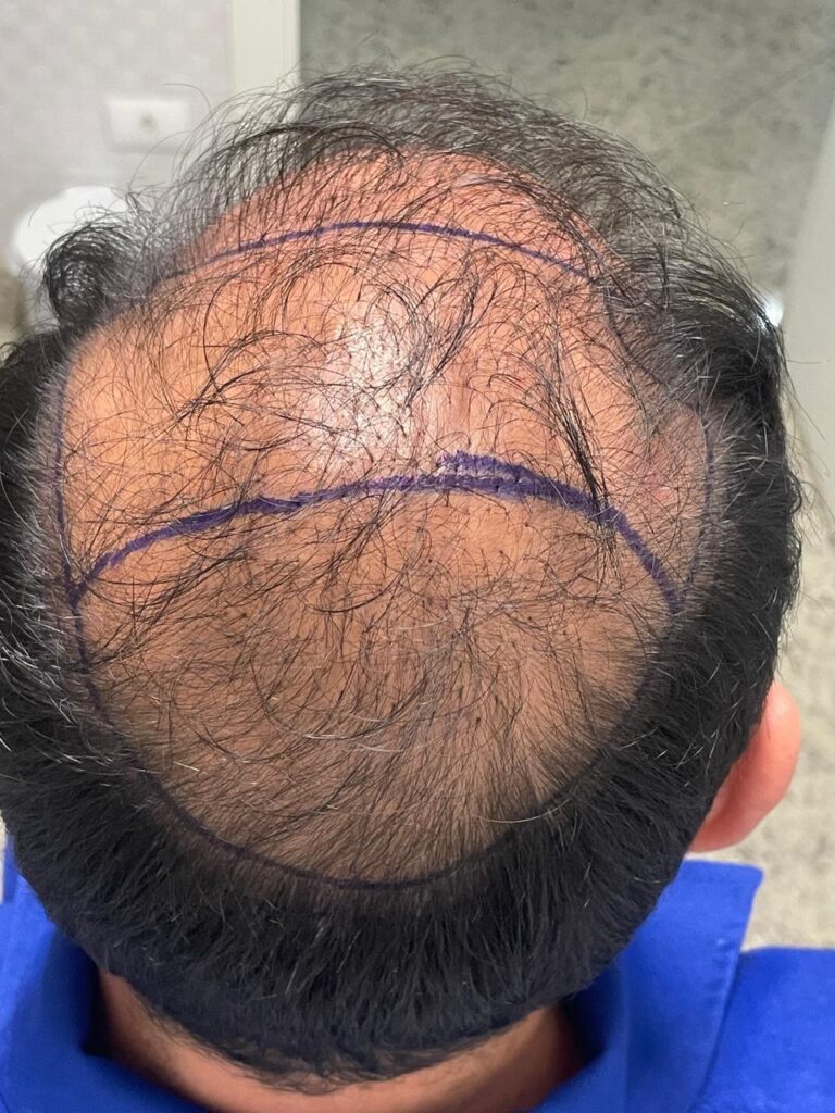 Transplante capilar: da raiz ao resultado – Por que escolher um especialista faz toda a diferença 2 WhatsApp Image 2025 06 23 at 09.08.59 2