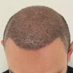 Transplante capilar: da raiz ao resultado – Por que escolher um especialista faz toda a diferença 2 WhatsApp Image 2025 06 23 at 09.08.59 3