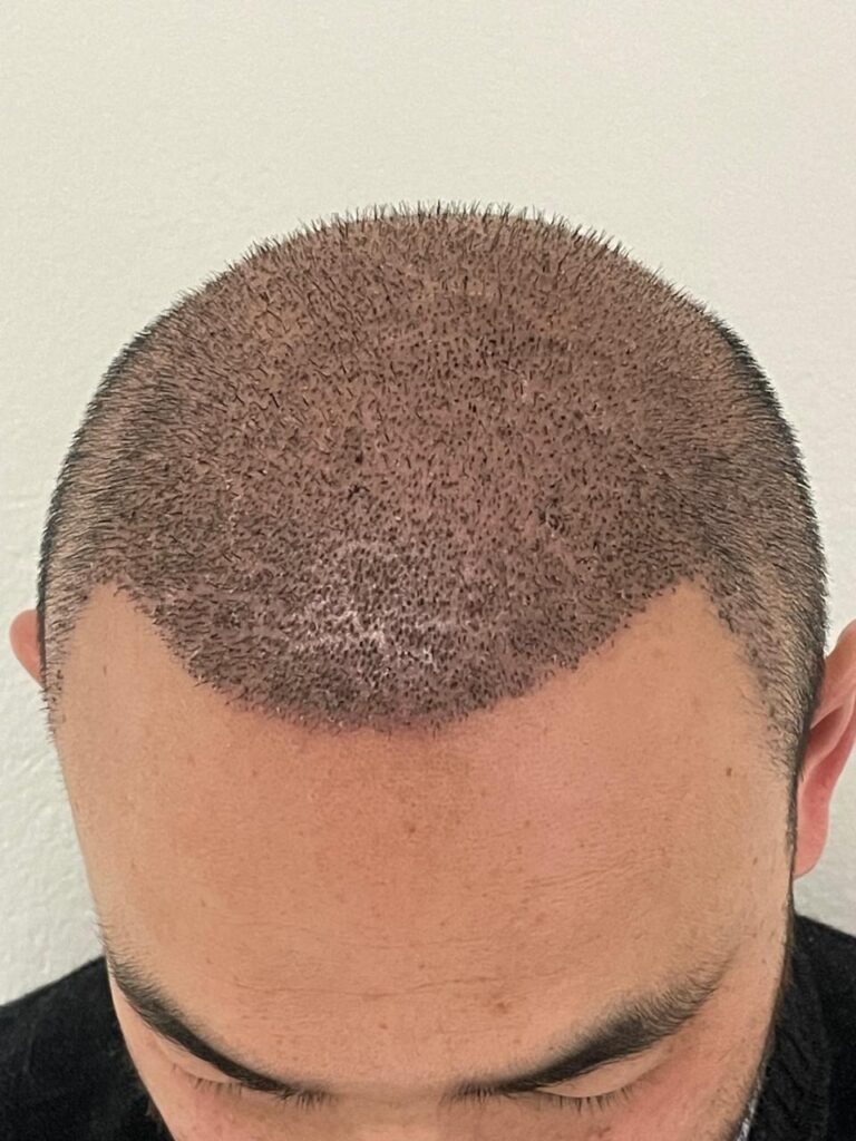 Transplante capilar: da raiz ao resultado – Por que escolher um especialista faz toda a diferença 9 WhatsApp Image 2025 06 23 at 09.08.59 3