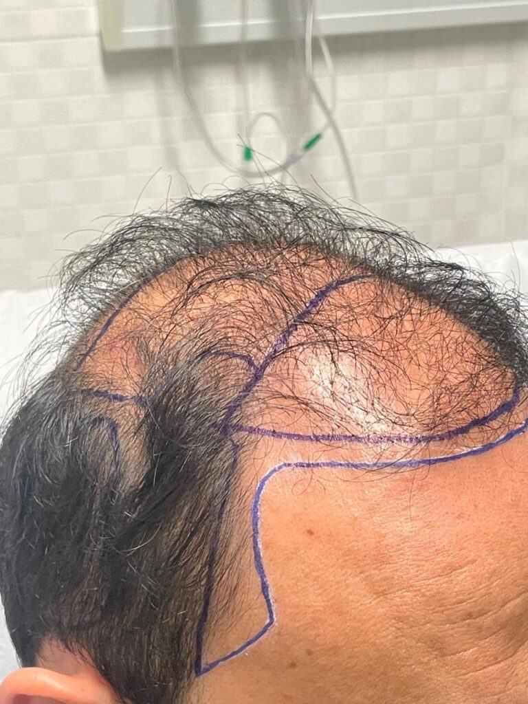 Transplante capilar: da raiz ao resultado – Por que escolher um especialista faz toda a diferença 4 WhatsApp Image 2025 06 23 at 09.08.59